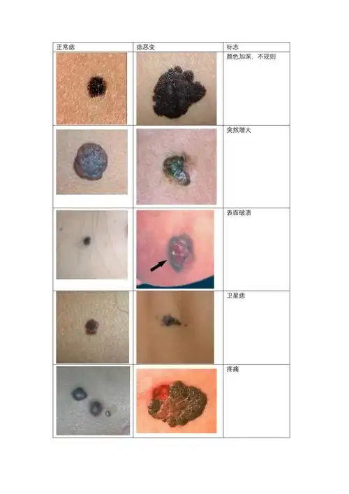 什么样的痣会变成癌