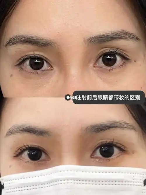 眼窝填充_嗨体_熊猫_泪沟_眼部_消肿_双眼皮_眼窝泪沟填充_美妆_医美