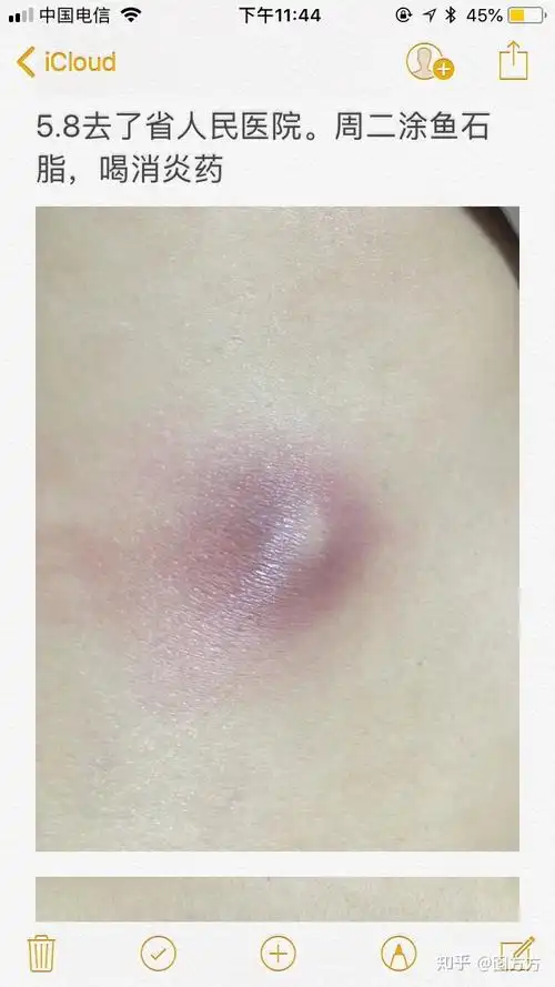 原来我长的不是疖子而是皮脂腺囊肿又称粉瘤 - 知乎