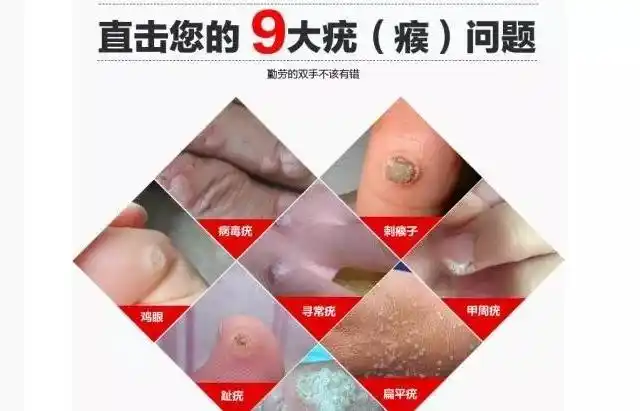 患了具有传染性的扁平疣应该怎么办