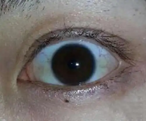 贫血的人有五大典型症状转发让更多的人知道