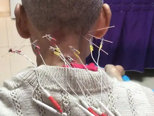 醒脑开窍针灸治疗中风病