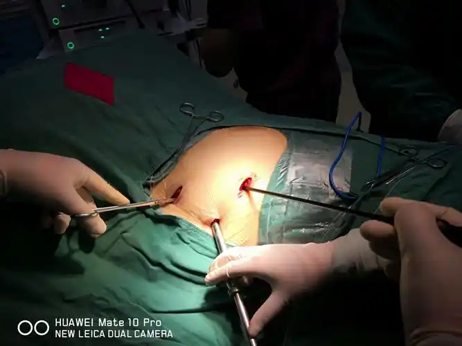 胸腔镜下微创前纵隔肿瘤切除 - 好大夫在线