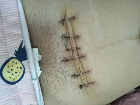 还行吧,我用的美容刀口拆线的那种