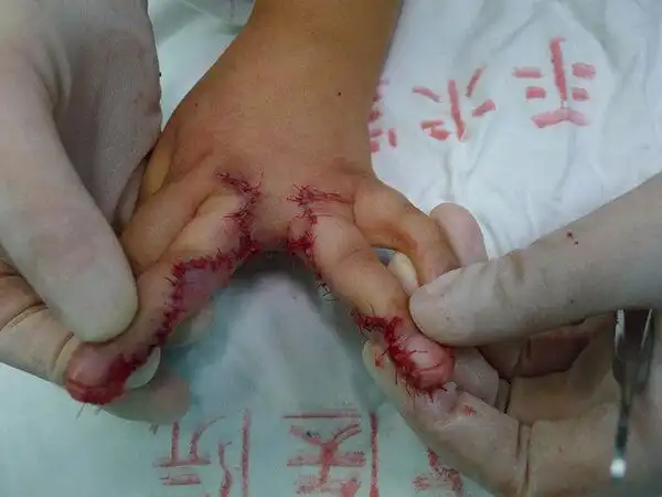 双翼皮瓣成形指蹼-——并指不植皮或减少植皮的新方法 - 好大夫在线