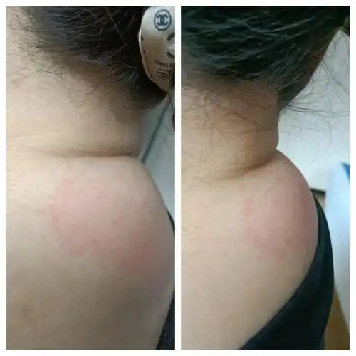 见面的第一眼我就被她脖子后面的富贵包给吸引了视