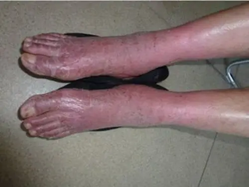 孕妇疥疮初期腹部皮肤症状图片