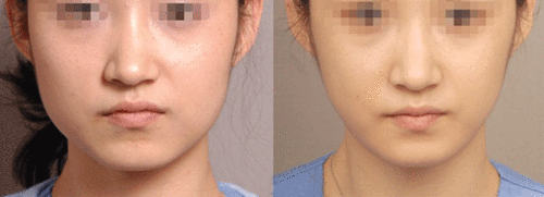 瘦脸针能不能永久瘦脸