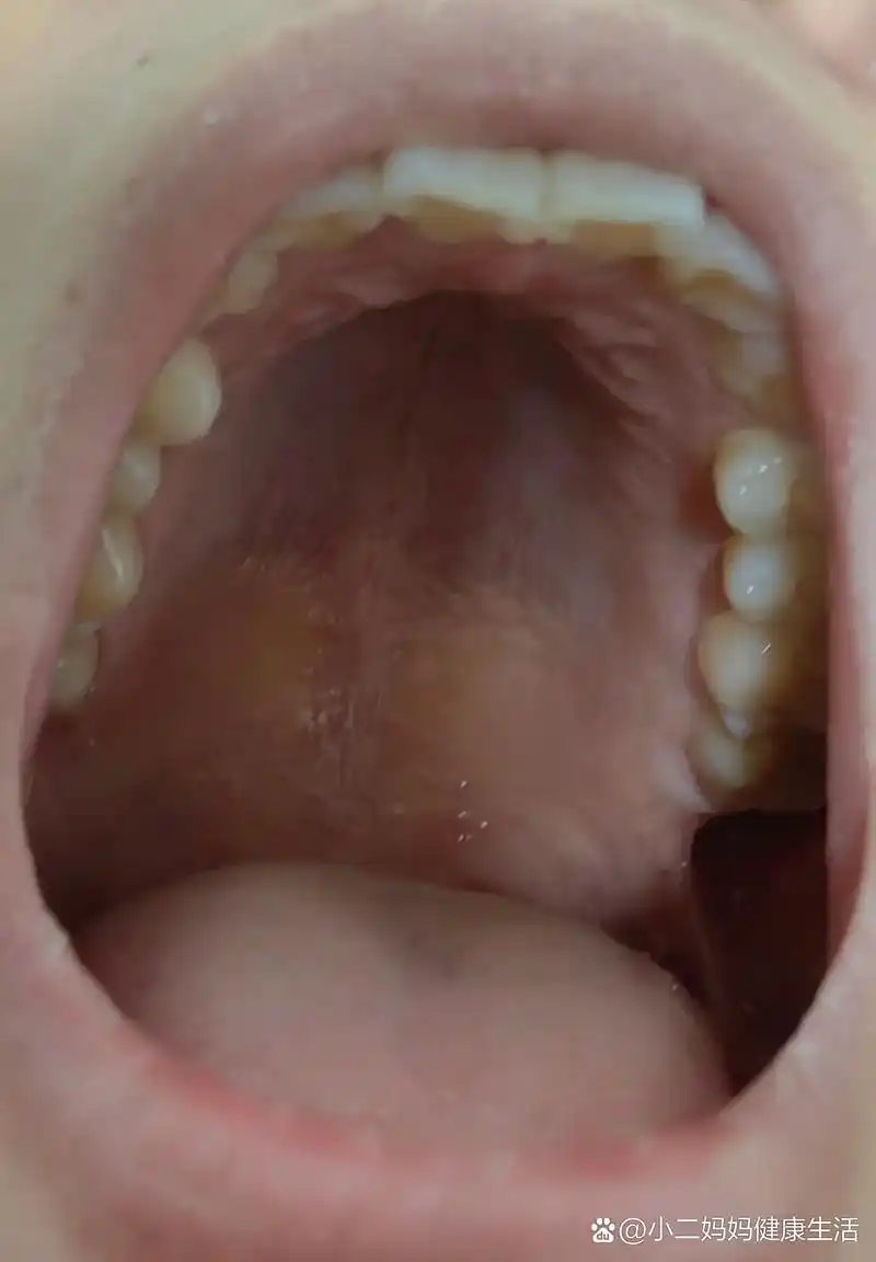 上颚都是小泡
