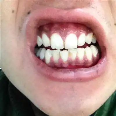 牙龈发白是怎么回事