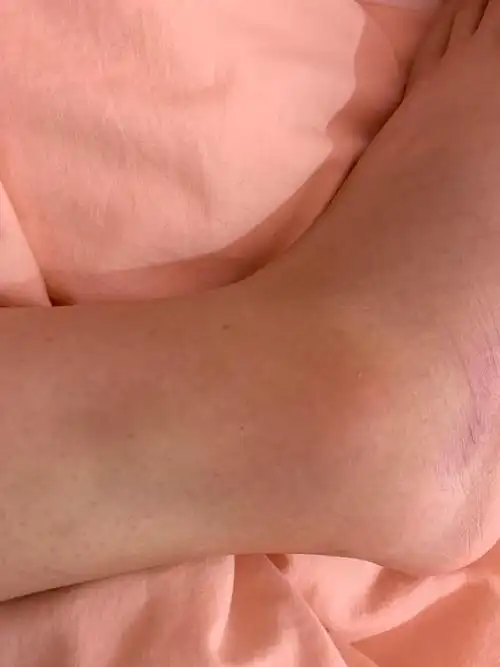 拉伤后,踝关节周围的血管会扩张,引起局部肿胀,并有