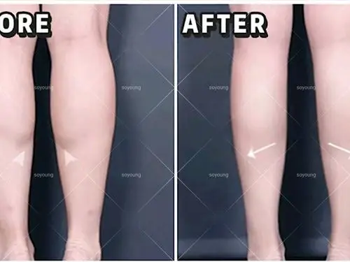 图片是我一共打了3次瘦腿针之后的效果 每隔半年