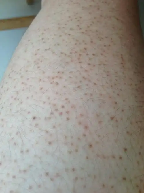 腿上手上有很多小红点.密密麻麻的 但又不痛不痒.