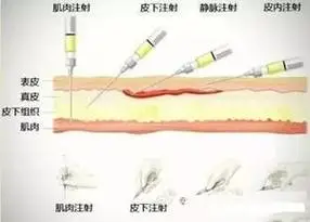 各种注射方式的缩写