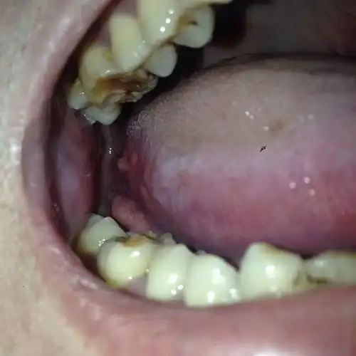 舌缘长了一个小疙瘩很疼!