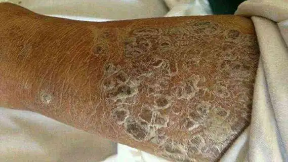 癞皮病和烟酸的发现