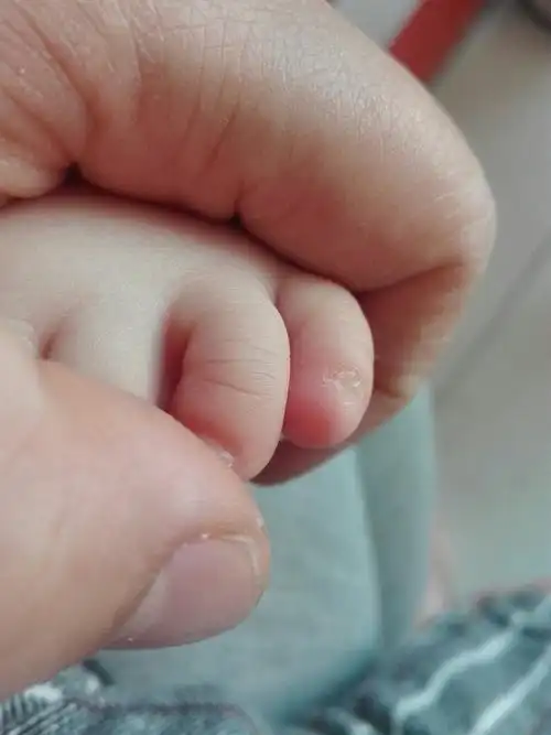 一岁的宝宝小脚趾甲长的是一坨