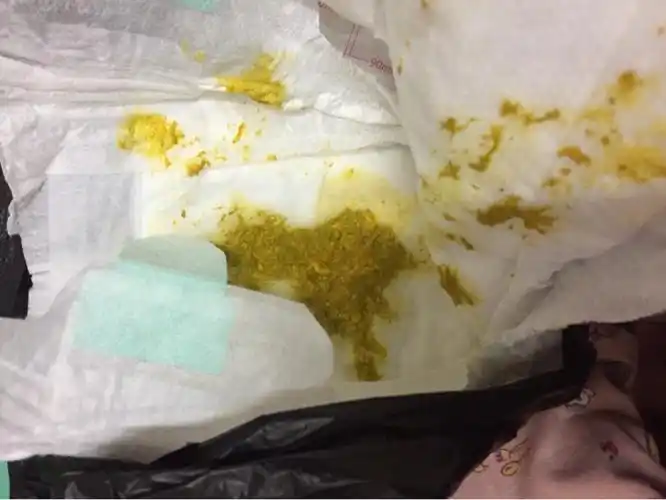 我宝宝刚出生24天,今天拉了四次大粑粑,然后有三次是很小一丢丢的