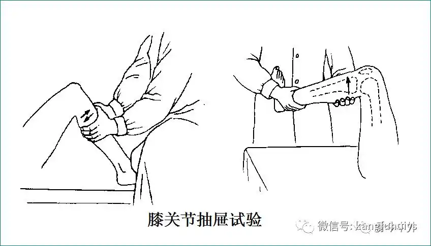 常见的足部畸形2.跟腱损伤检查3.踝部前抽屉试验