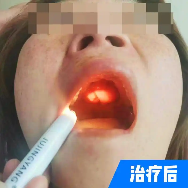 这是最近门诊接诊的山西刘女士,诊断是上颚癌,出现明显的溃疡,出血