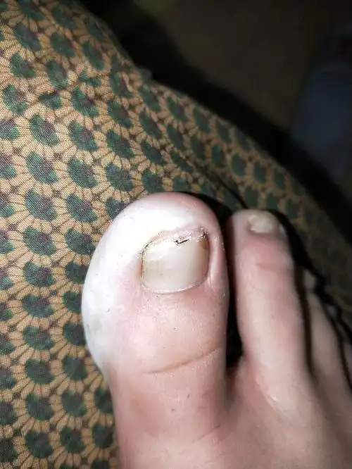 大拇指越边缘越严重,侧面的气就像是坏死了一样,厚厚的一层白皮.