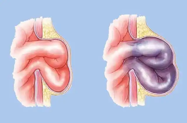 狐疝相当于西医学的腹股沟斜疝以婴儿和中老年男子较多