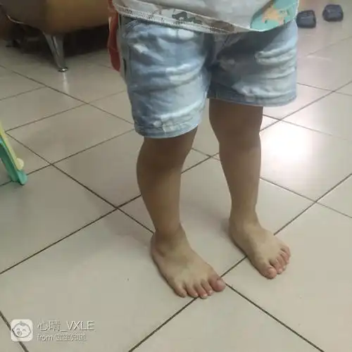 三岁半o型腿走路内八字有矫正好的吗