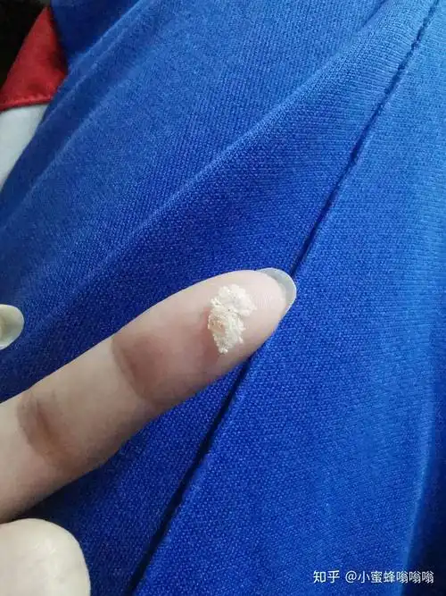 为什么抠下来大块的头皮屑会有瞬间的快感? - 知乎