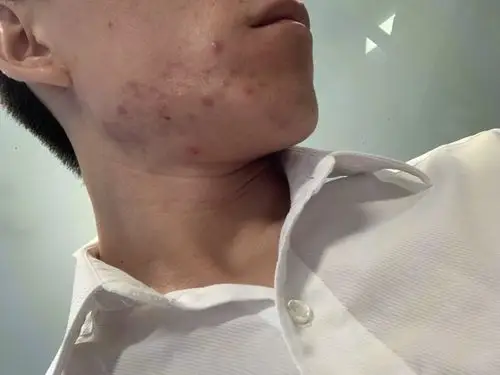 你好医生我淋巴腮帮部位一直会反复长痘痘不知道是不是内分