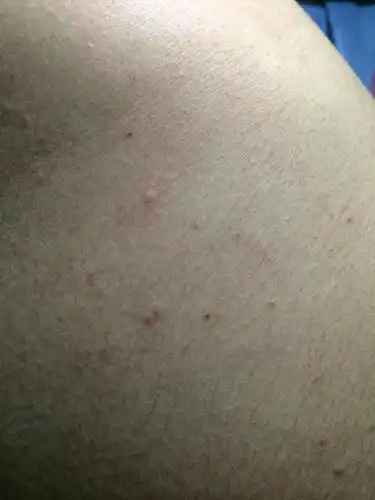 睾丸上都是红疙瘩,特别痒,怎么办