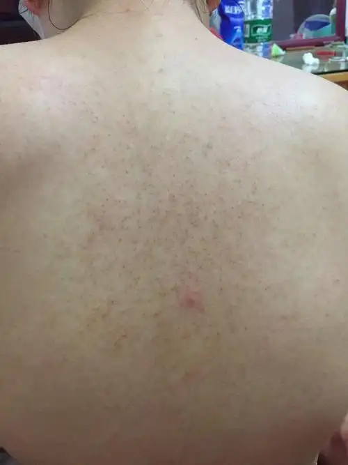 后背上有一片黑点,手臂上也有些,已有多年,十多岁开始就有,十几年了