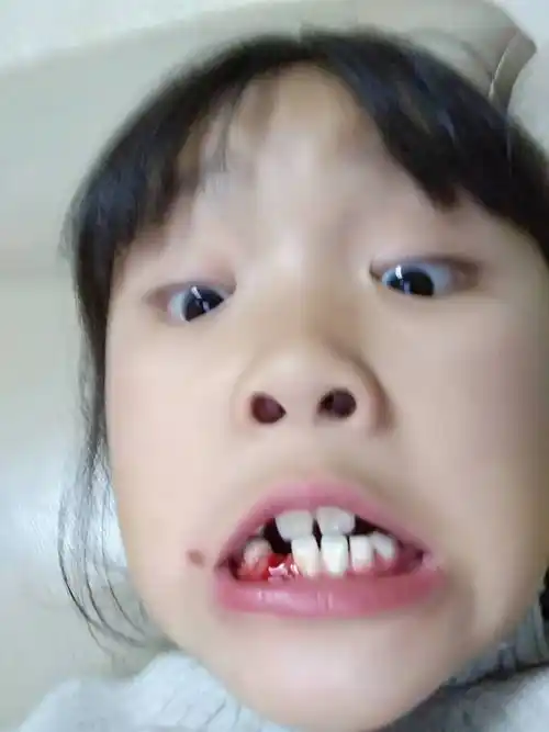 中午梦见牙齿掉了好多颗_梦到自己掉好多牙齿_孕妇梦见掉好多牙齿