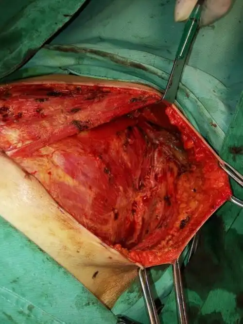 一例晚期乳腺癌皮瓣修复手术