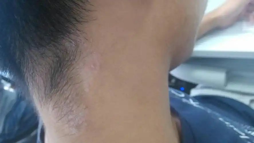 有什么验方可以根治或者治疗的?谢谢