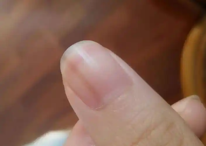 指甲上有竖纹,究竟是咋回事?是老人说的肝不好吗?
