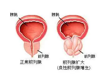 前列腺肥大的原因