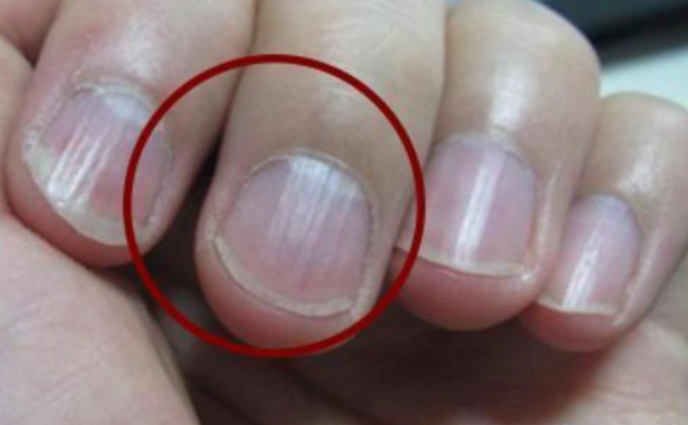 指甲上出现多条竖纹,别瞎猜了,有可能是身体出现了问题