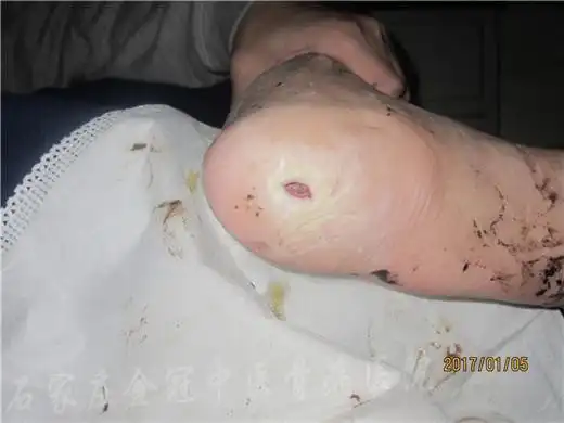 这是河北邢台吉先生跟骨骨髓炎,伤口情况很糟糕,也是流脓流水.
