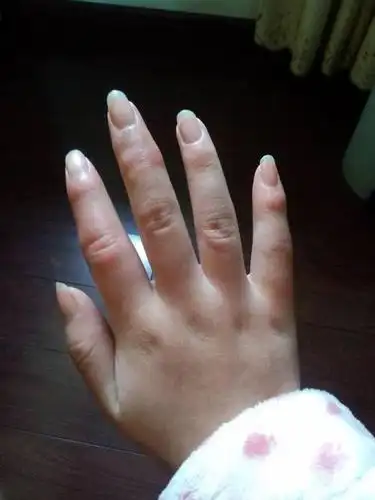 脚部长冻疮的症状_39健康经验