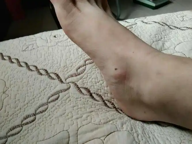 我来告诉大家副舟骨手术的问题