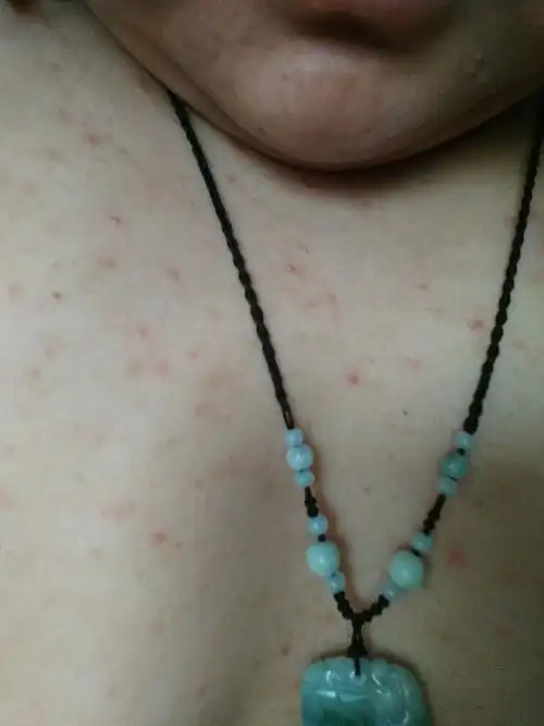 胸口长了很多痘痘,不知道怎么消除