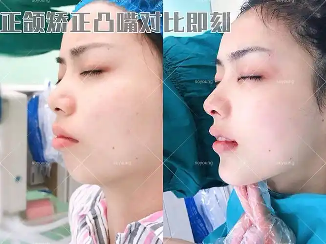 正颌矫正凸嘴对比即刻