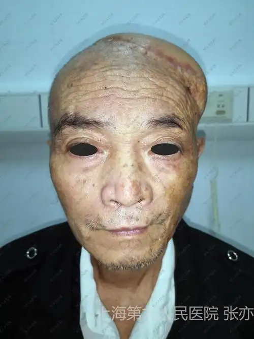 头皮鳞癌_鳞状细胞癌 - 好大夫在线