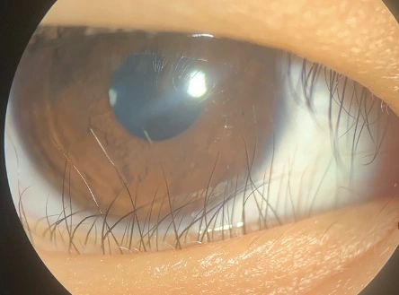 1-3根少量的睫毛,可以尝试拔除或者电热定型.