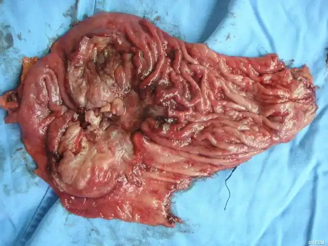 【交流】巨大胃溃疡图片(很典型的图片,看图说话,出病理了) [病例帖]