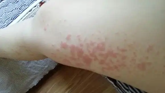 大腿内侧痒痒越抓越痒有小红疙瘩,该怎么办呢