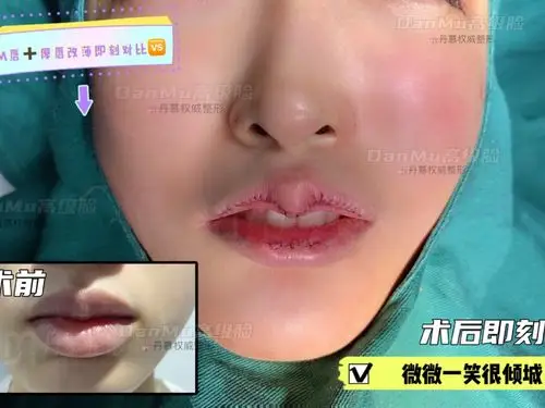 m唇77厚唇改薄对比