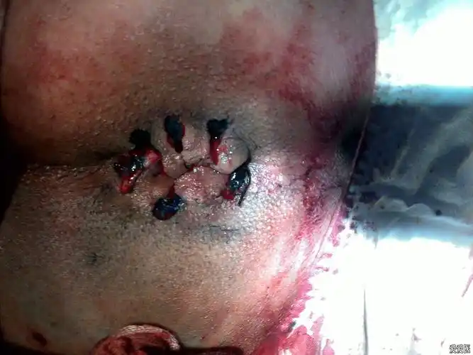 热烈祝贺滨州援建祁连县人民医院肛肠中心成立!(副本)