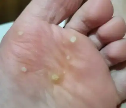 硬核科普关于跖疣你想了解的都在这里