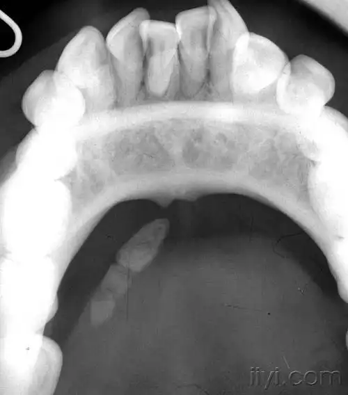 分享颌下腺主导管腺体外导管结石一例